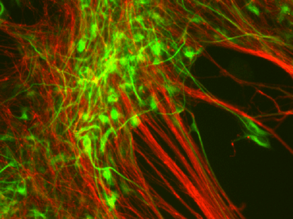 Swedish Medical Products Agency grants approval for clinical study of new stem cell based Parkinson’s Disease&nbsp;treatment