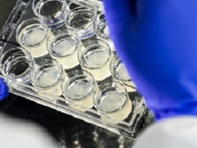 Parkinson’s disease Thomas received seven million lab-grown brain&nbsp;cells